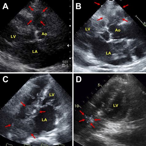 Understanding Normal vs Abnormal Echocardiogram Results.